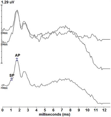 Human Summating Potential Using Continuous Loop Averaging Deconvolution: Response Amplitudes Vary with Tone Burst Repetition Rate and Duration